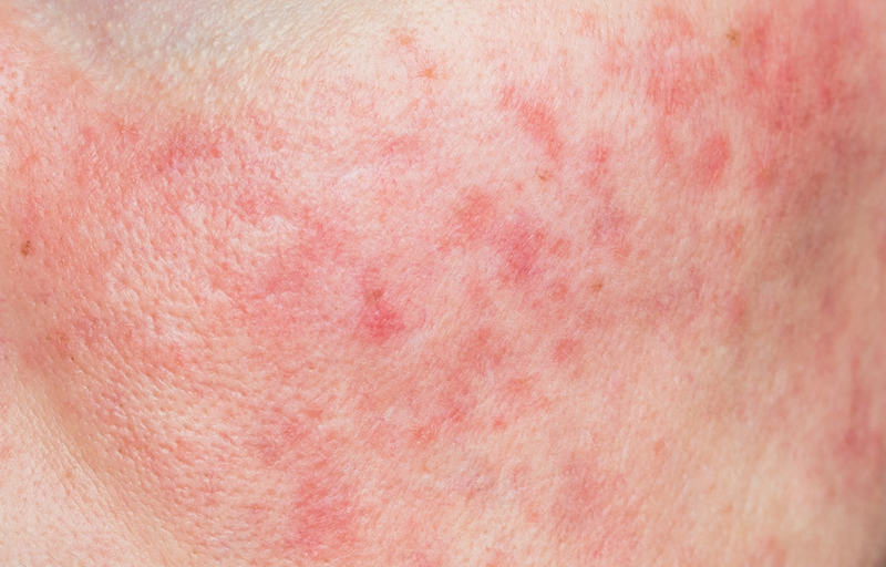 Гайд по чувствительной коже